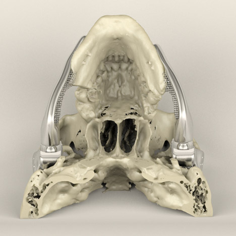 Custom-fit-3D-printed-medical-implant-bone-reconstruction-Sebastiaan-Deviaene_dezeen_05_468